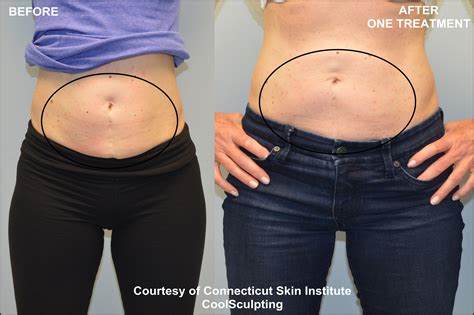 coolsculpting philippines|CoolSculpting Fat Freezing Treatments, Side Effects & Results.